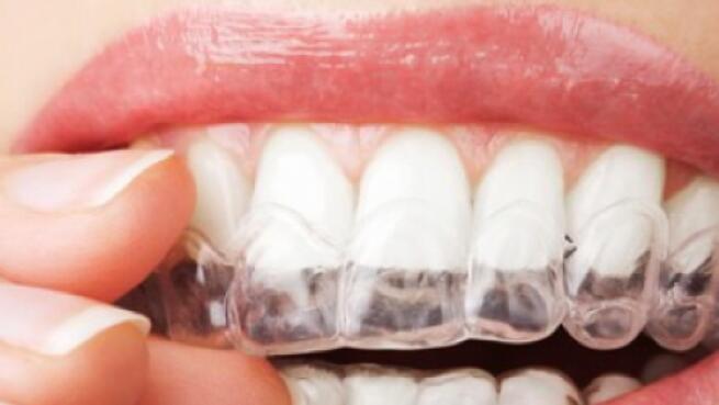 Blanqueamiento Dental En Casa Con Ferulas Personalizadas Por Profesionales Por 99 Oferta Con Descuento 43 Ofertas En Malaga Oferplan Diario Sur