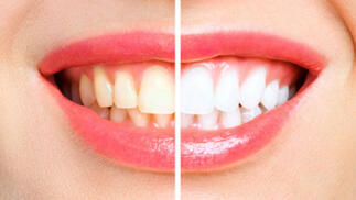 Tratamientos dentales al mejor precio